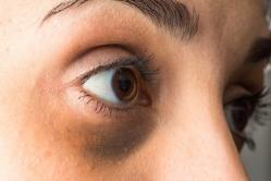 Что нужно делать, чтобы убрать пигментные пятна вокруг глаз?